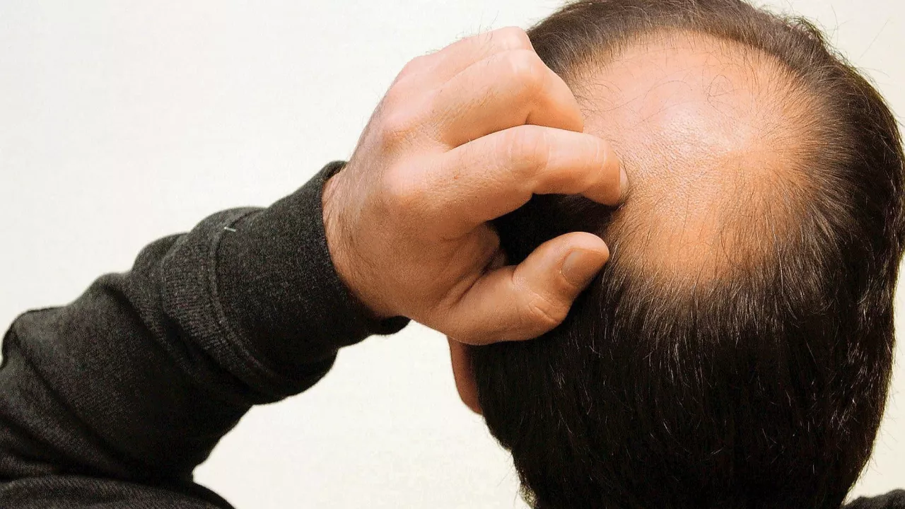 Boire du soda favoriserait l'apparition de la calvitie Boire du soda favoriserait l'apparition de la calvitie