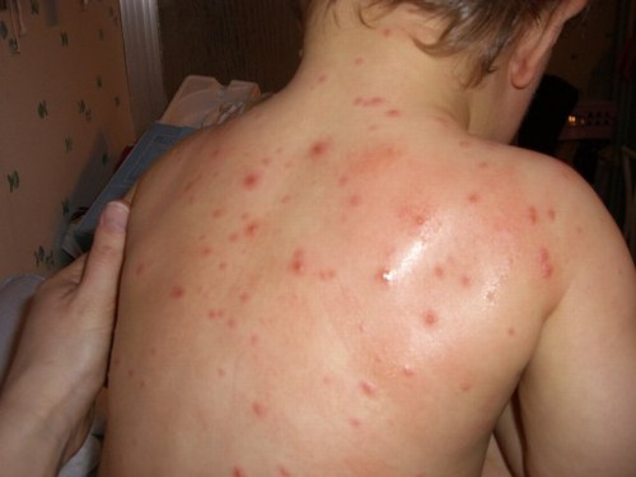 Rh&ocirc;ne-Alpes fortement touch&eacute;e par la varicelle